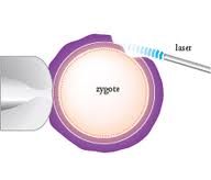 Laser assisted hatching and assisted hatching blastocyst , assisted egg hatching