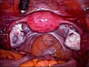 Laparoscopic picture of a normal female pelvis