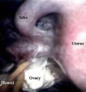 Laparoscopic photo of an abnormal pelvis with severe scarring